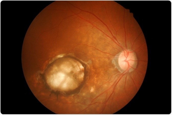Medical photo Age-related macular degeneration (AMD). Image Credit: memorisz / Shutterstock