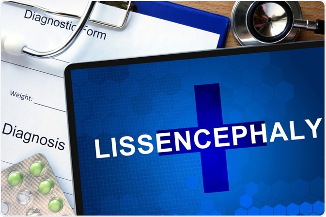 Lissencephaly