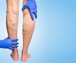 What Causes Varicose Veins?