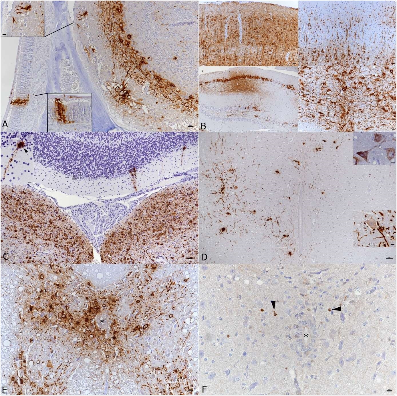 Brain and spinal cord, K18-hACE mice, day 7 post intranasal SARS-CoV-2 infection (104 PFU as single infection or 103 PFU after initial infection with IAV (102 PFU IAV strain A/X31) as double infection). A) Double infected animal, main olfactory epithelium (MOI), cribriform plate and olfactory bulb. Viral antigen is detected in olfactory neurons and basal cells of the MOI and in granule layer, inner and outer plexiform layer, mitral layer as well as glomerular layer of the olfactory bulb. Bar = 20 μm. B) Double infected animal, examples of viral antigen expression in different brain regions. Top: frontal cortex with viral antigen expression in almost all neurons = 20 μm. Bottom: patchy virus antigen expression in the hippocampus (CA1 and CA3; left; bar = 50 μm.) and strong expression in the medulla oblongata (right; bar = 20 μm.). C) Single infected animal, medulla oblongata and cerebellum. Viral RNA is abundantly expressed in neurons in the medulla oblongata (vestibular nuclei). The cerebellar cortex exhibits a few positive Purkinje cells (see also inset). Bar = 50 μm. D) Single infected animal, thoracic spinal cord. The grey matter exhibits numerous neurons that express viral antigen (large image and bottom inset) and viral RNA (top inset) in cell body and processes. Bar = 50 μm. E, F) Double infected animal, thoracic spinal cord. There is extensive viral antigen expression in neurons in the grey matter (E). Consecutive section showing scattered apoptotic (cleaved caspase 3 positive) glial cells (F, arrowheads), among intact neurons and in the absence of an inflammatory reaction. * - central canal. Bars = 20 μm. Immunohistochemistry and RNA-ISH, hematoxylin counterstain.
