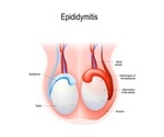 What is Epididymitis?