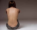 Anorexia Nervosa Complications