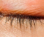 Blepharitis Complications