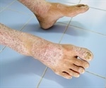 Scleroderma Diagnosis