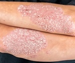 Psoriasis Genetic Factors