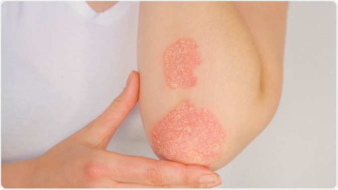 psoriasis