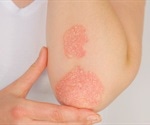 Psoriasis Diagnosis