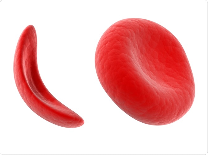 Sickle Cell