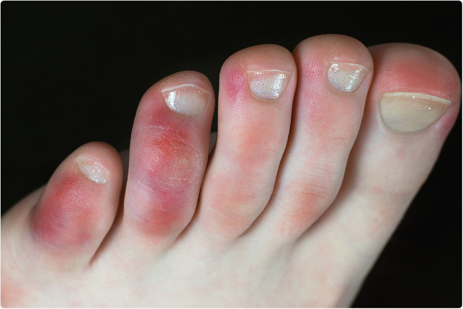 Review: Clinical Manifestations of COVID-19 in the Feet: A Review of Reviews. COVID toes: Image Credit: Tunatura / Shutterstock