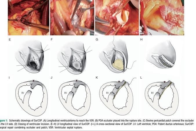 Novel surgical technique shows promise to repair ruptures caused by heart attacks