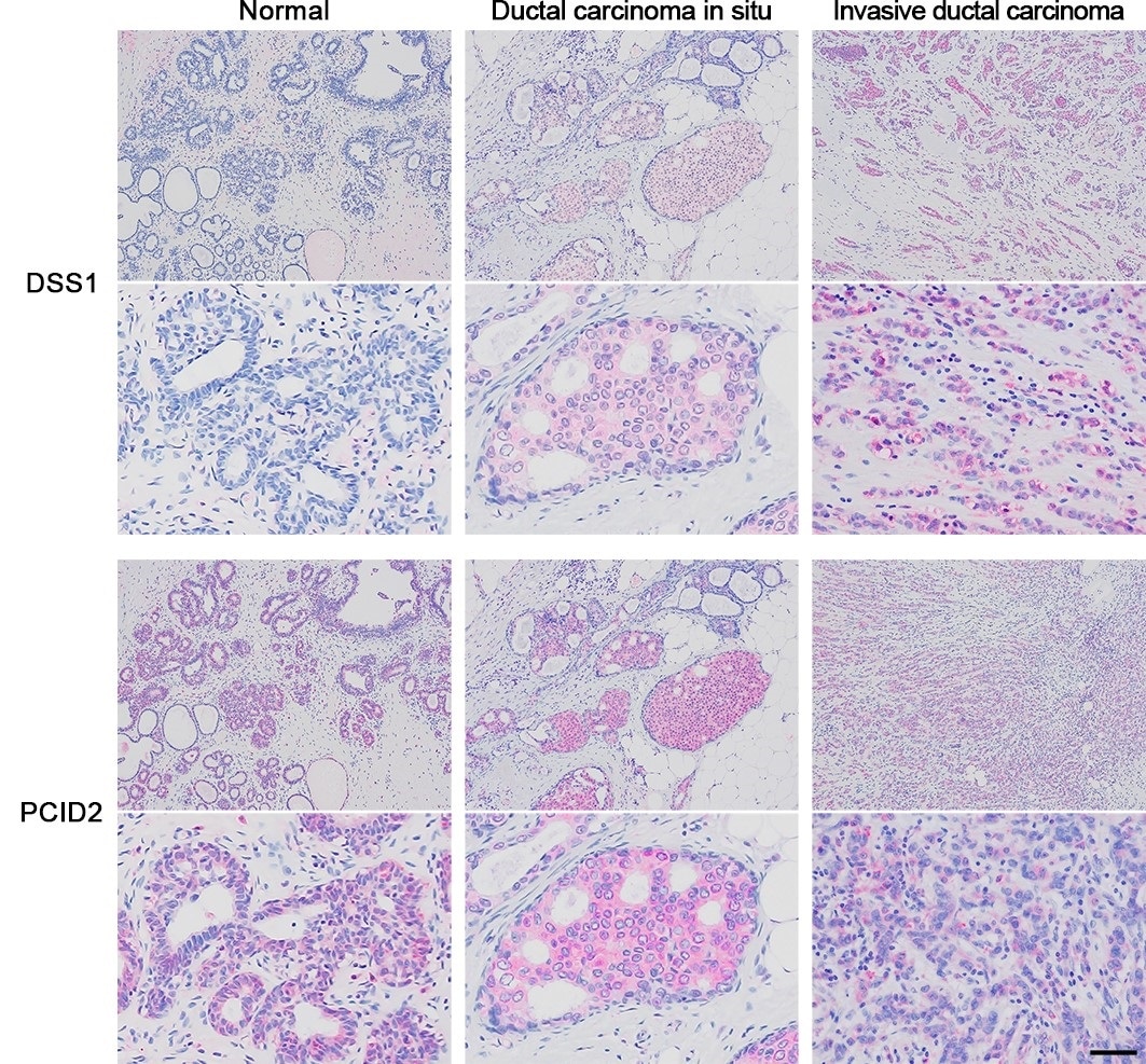 Study offers hope for an era of safer chemotherapy in breast cancer