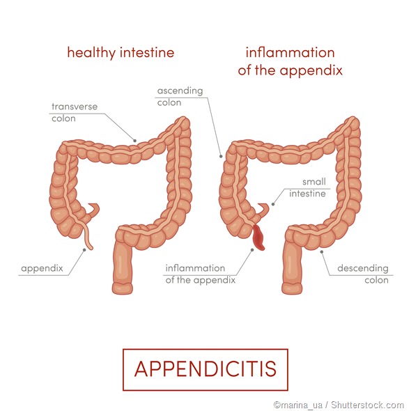 Appendix inflammation