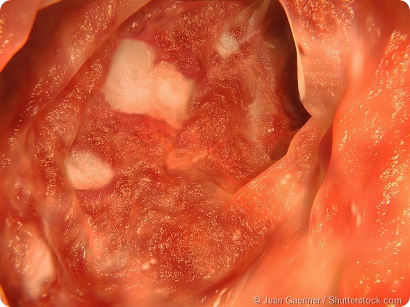 Colon mit Colitis ulcerosa