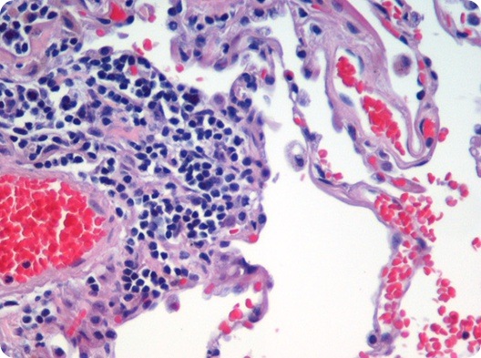 Image is of H&E (haematoxylin and eosin) stained lung tissue sample taken from an end-stage emphysema patient. Cell nuclei are blue-purple, red blood cells are red, other cell bodies and extracellular material are pink, and air spaces are white. Source: