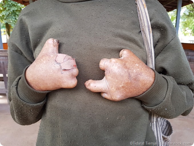 Fingers lost leprosy sufferer