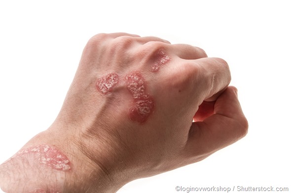Psoriasis of the hand