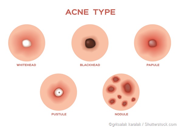 Types of acne illustration