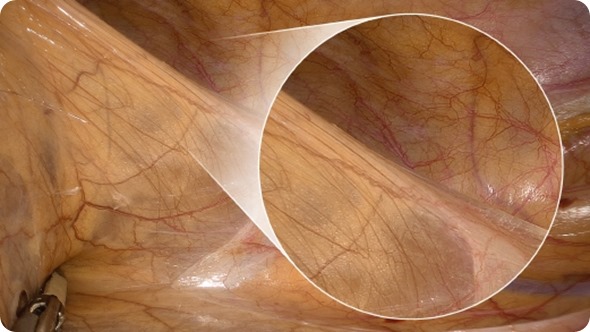 UHD Resolution of an Endoscopy