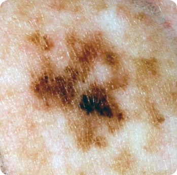 Melanoma