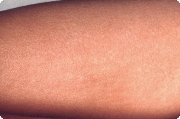 scarlet fever rash