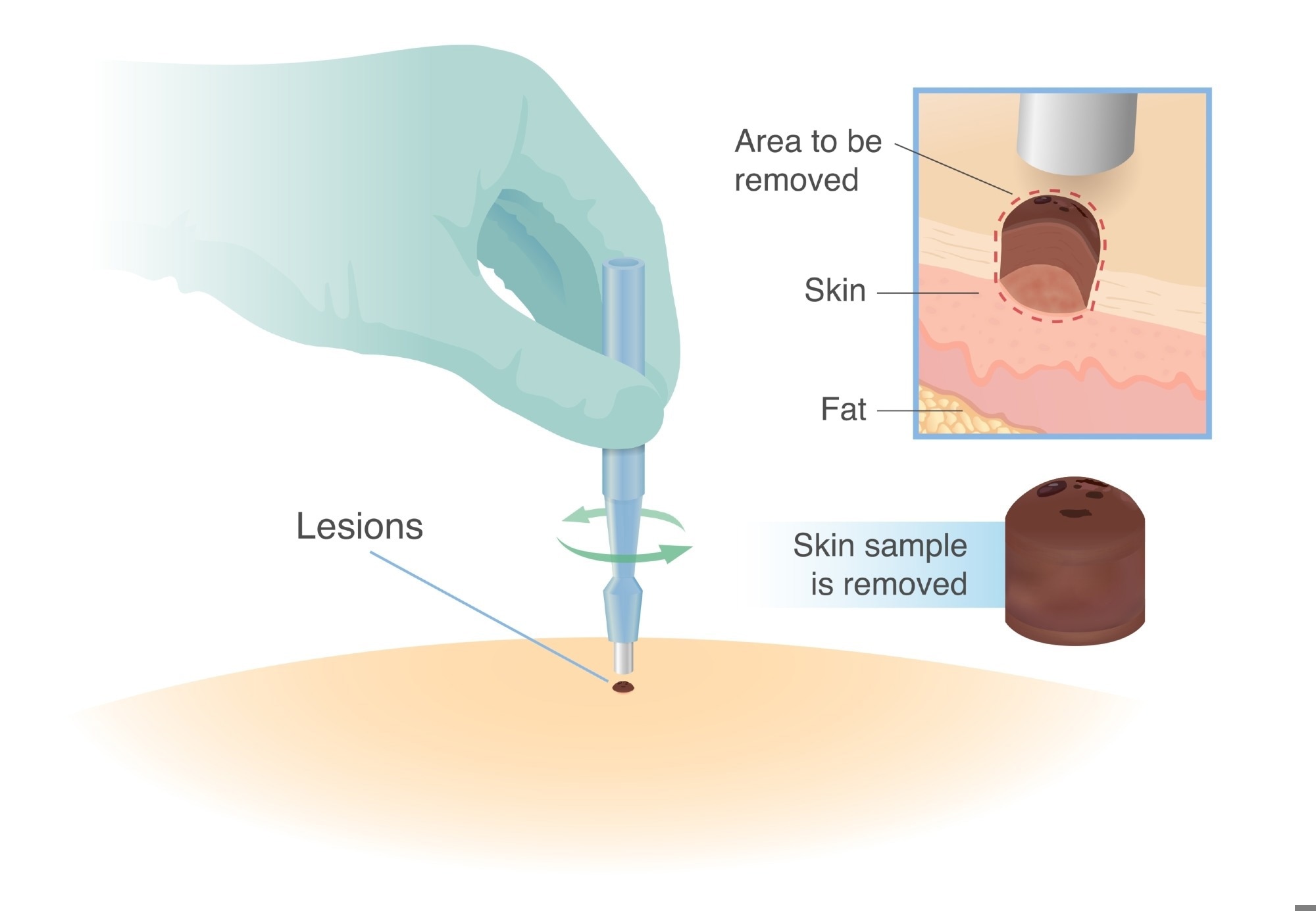 A medical illustration of a punch biopsy procedure showing a gloved hand using a circular biopsy tool to remove a small skin sample from a lesion. The diagram includes an inset highlighting the layers of skin and fat, with labels indicating the area to be removed and the extracted cylindrical skin sample.