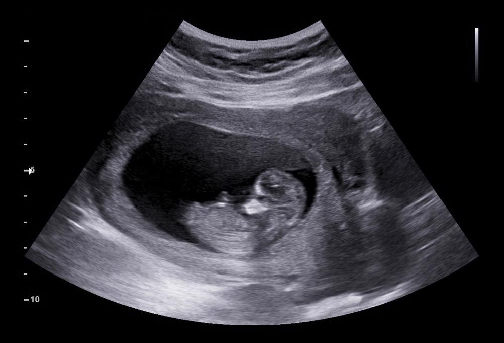Ultrasound of human fetus
