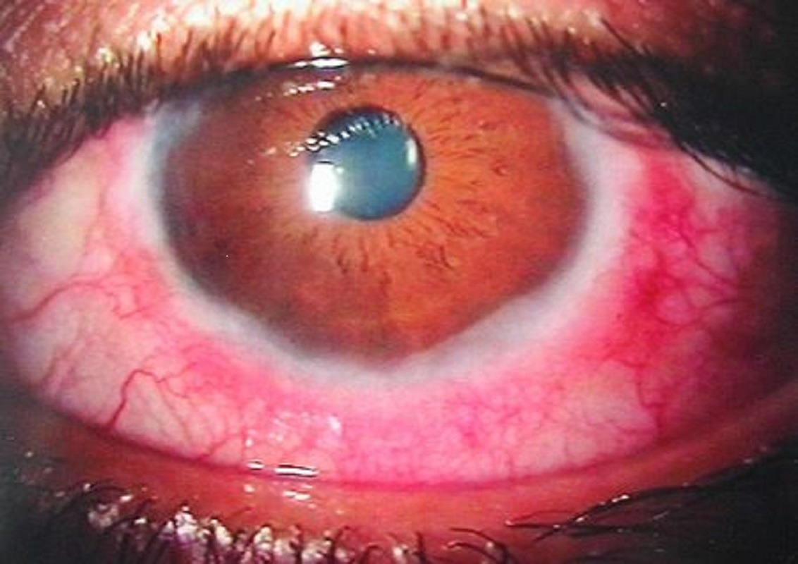 Vernal conjunctivitis. Image Credit: https://en.wikipedia.org/wiki/Vernal_keratoconjunctivitis