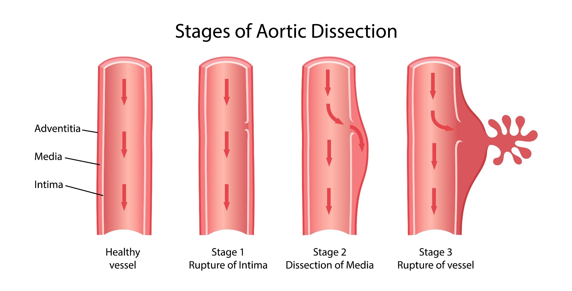 Aortic dissection