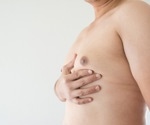 What is Gynecomastia?