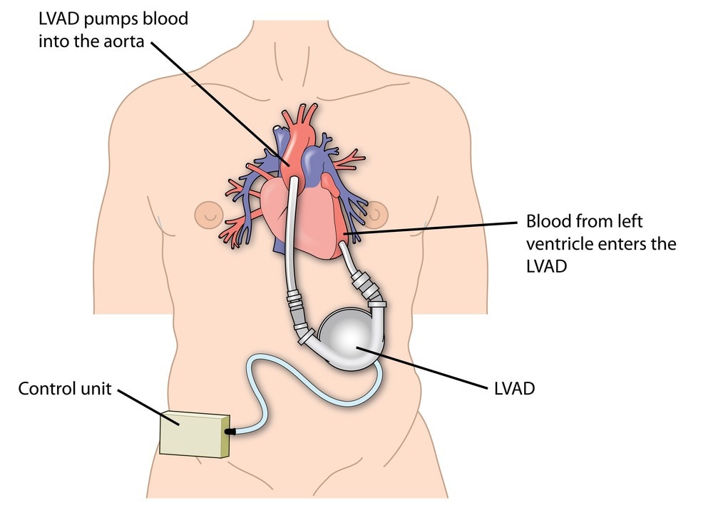 Left ventricular assist device attached to the left ventricle of the heart and the aorta. Image Credit: Blamb/Shutterstock.com