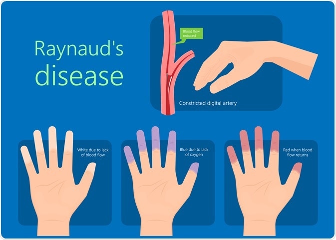 raynaud