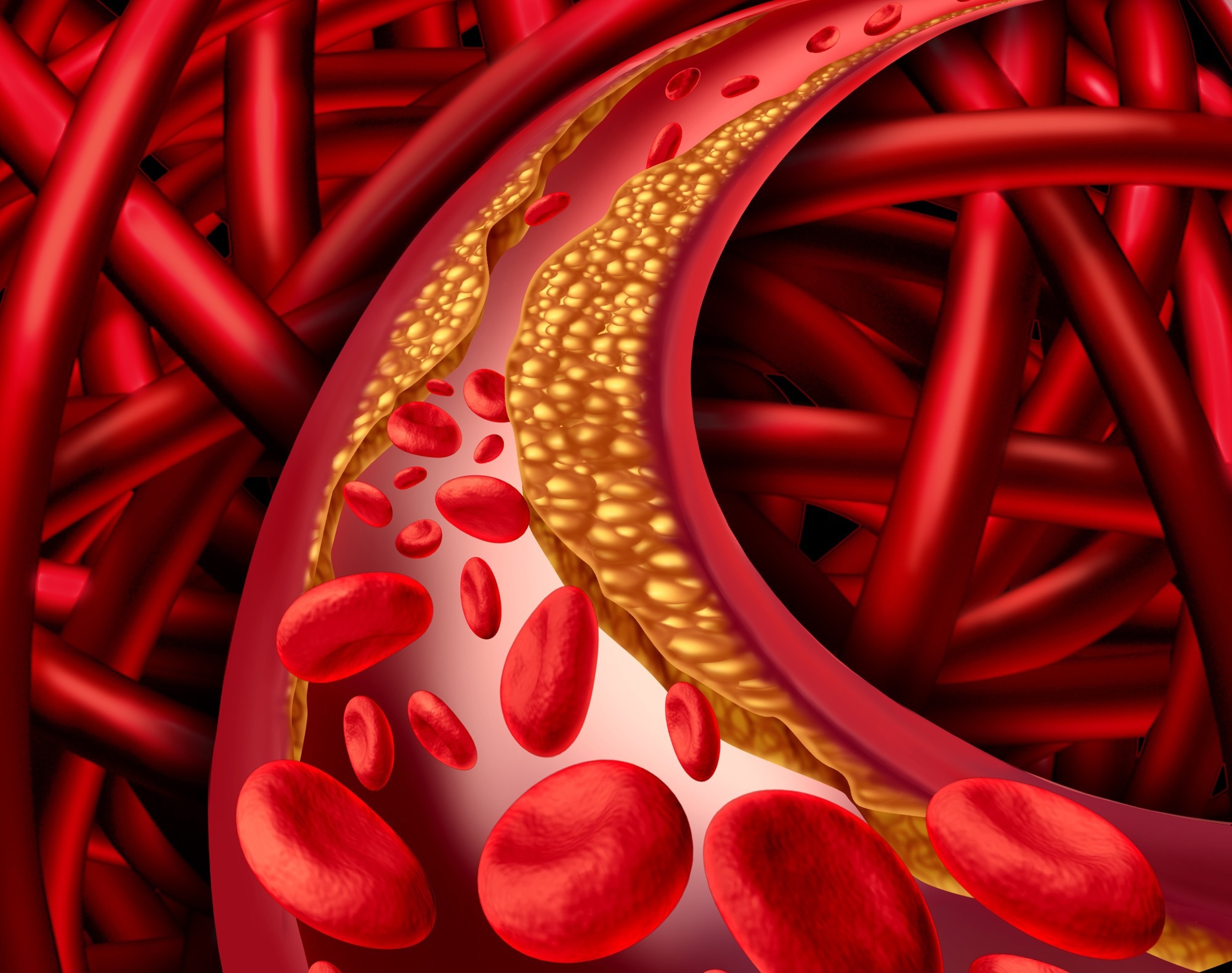 Atherosclerosis. Image Credit: Lightspring / Shutterstock