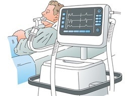 Reducing the instance of patient-ventilator dyssynchrony through pressure sensor technology