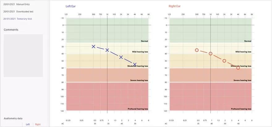 The Short Increment Sensitivity Index (SISI) test: Assessing auditory nerve and inner ear function