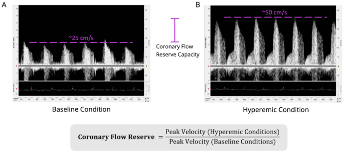 Coronary Flow Reserve Measurements and Imaging in Wildtype C57BL/6 Mouse. Shown is the A) coronary blood flow velocity at a physiologically baseline level (~1% isoflurane levels; peak blood flow velocity ~25cm/second) and the B) same blood flow at a hyperemic level (~2.5% isoflurane levels; peak blood flow velocity ~50cm/second). Scales are the same for both images (-15 to 65cm/sec). The equation to calculate coronary flow reserve is shown below (the CFR for this animal would be 2.0 in this example). Isoflurane was used as a vasodilator, but vasodilator of choice can be used. Electrocardiogram was recorded simultaneously to ensure appropriate timing of obtainment of blood flow signals and to determine heart rate. The left anterior descending artery was measured