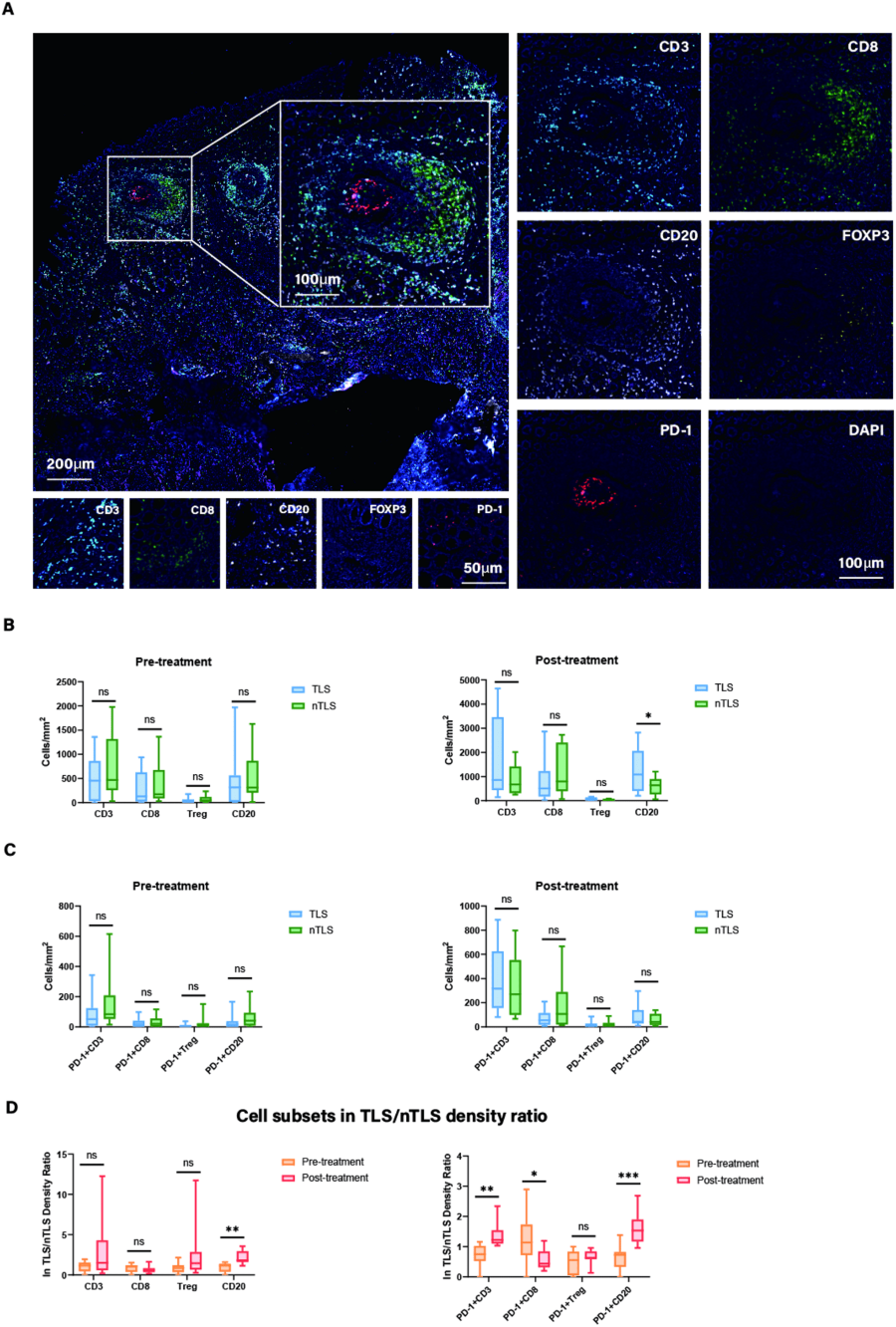 From Figure 5. Liu X, Xu D, Zhou C, Zhong Y, Geng H, Huang C, Shen Y, Xia X, Wang C, Zhu C, Cao H. Association of PD-1 + Treg/PD-1 + CD8 ratio and tertiary lymphoid structures with prognosis and response in advanced gastric cancer patients receiving preoperative treatment