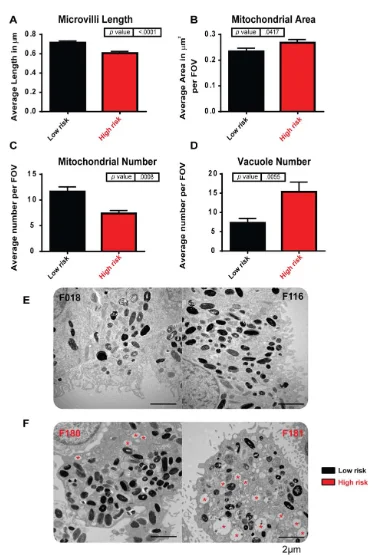 iPSC-derived retinal pigment epithelium (RPE) modelling AMD. iPSC-derived RPE generated from high-risk Y402H AMD donors (F180 and F181) show ultrastructural changes when compared to low-risk Y402H donors (F018 and F116). (A): Microvilli length is decreased in high-risk donor RPE. (B): Mitochondrial area was increased in high-risk donor RPE. (C): Mitochondrial number was decreased in high-risk donor RPE. (D): The number of vacuole structures was greatly increased in high-risk donor RPE. (E): Examples of low-risk iPSC-RPE cells: left hand side, F018; right hand side, F116; (F): Examples of high-risk iPSC-RPE cells: left hand side, F180; right hand side, F181; red asterisk indicates vacuoles