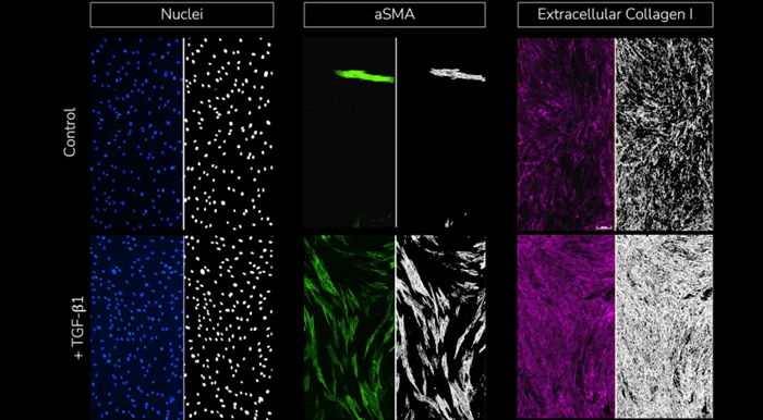 Split view images with fluorescent staining of cell nuclei, α-SMA and extracellular collagen I (left) and respective segmentation analysis masks (right) for each stained marker under control (un-stimulated, top) and TGF-β1 stimulated conditions (bottom)