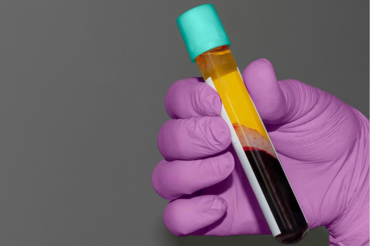 Study: Contribution of endogenous and exogenous antibodies to clearance of SARS-CoV-2 during convalescent plasma therapy. Image Credit: Elkhophoto/Shutterstock