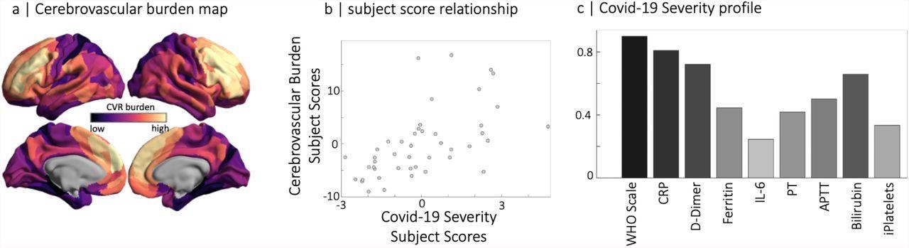 Partial least squares analysis of COVID-19 severity data at acute stage and RSFA-based cerebrovascular burden (CVB) at chronic stage. (panel a) Spatial distribution of parcellated RSFA values where dark to light colours are used for the strength of positive and negative correlations with the COVID-19 Severity profile (panel c). Note that regions with high cerebrovascular burden have low values in RSFA. The scatter plot in the middle panel represents the relationship between subjects scores of RSFA-latent variable and COVID-19 Severity-latent variable identified by partial least squares analysis.