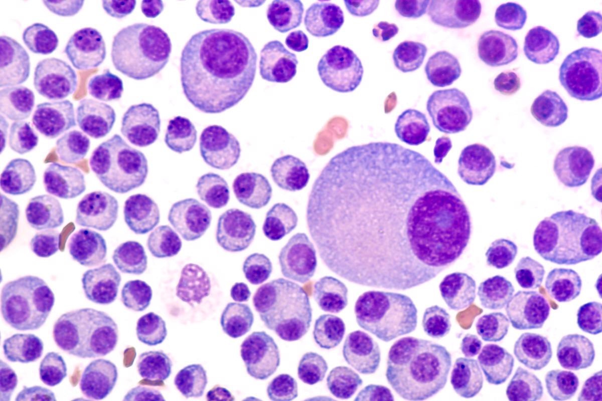 Study: Impact of Omicron variant on the response to SARS-CoV-2 mRNA Vaccination in multiple myeloma. Image Credit: David A Litman/Shutterstock