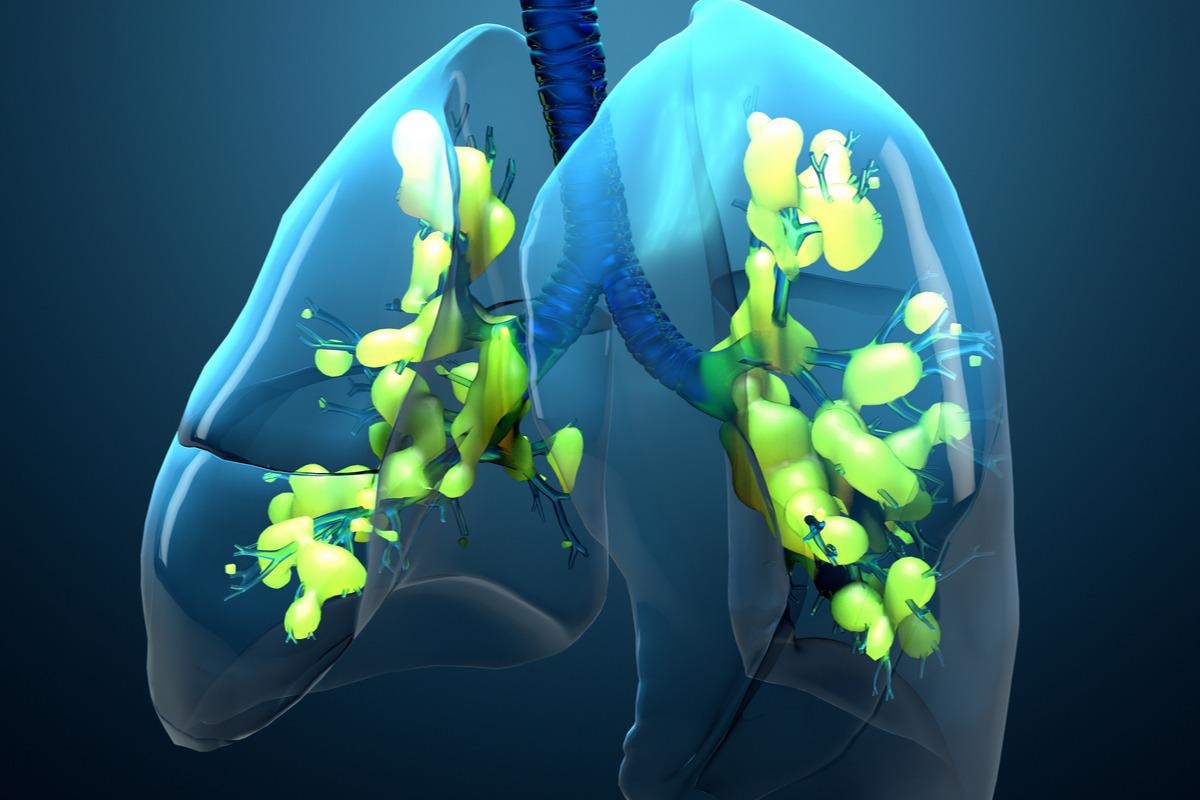 Study: Acute respiratory distress syndrome after SARS-CoV-2 infection on young adult population: international observational federated study based on electronic health records through the 4CE consortium ARDS after SARS-CoV-2 infection on young adult. Image Credit: Design_Cells/Shutterstock