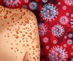 Researchers provide comprehensive review of human monkeypox infections