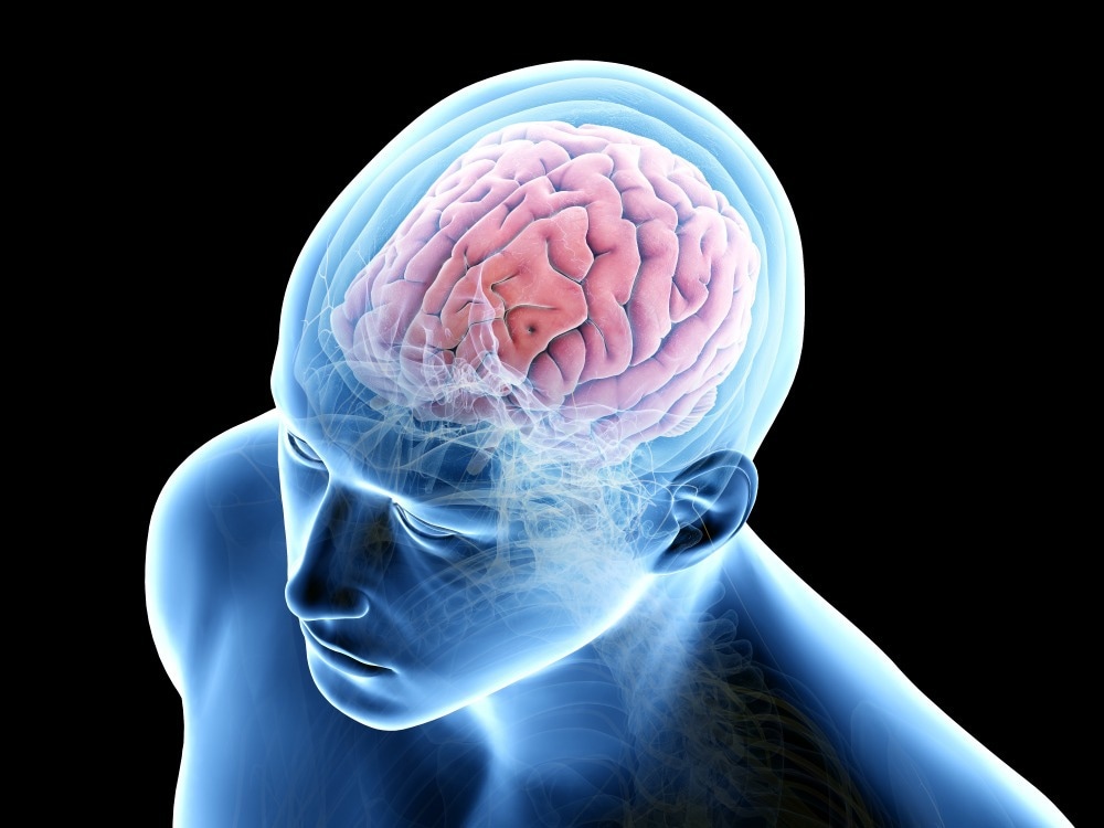 Study: Emerging Monkeypox Virus and Neuroinflammatory Disorders. Image Credit: SciePro / Shutterstock.com