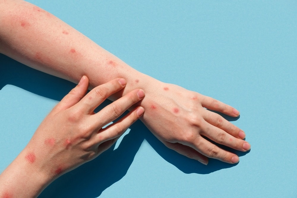 Study: Orthopoxvirus Testing Challenges for Persons in Populations at Low Risk or Without Known Epidemiologic Link to Monkeypox — United States, 2022. Image Credit: Marina Demidiuk/Shutterstock