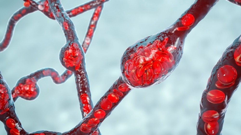 Study: Improvement of retinal function in Alzheimer disease-associated retinopathy by dietary lysophosphatidylcholine-EPA/DHA. Image Credit: Kateryna Kon/Shutterstock.com