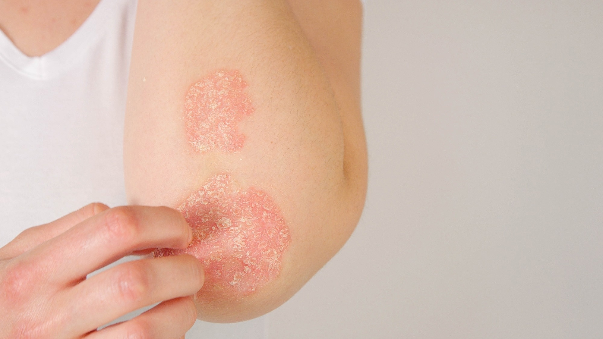 Study: Association between gut microbiota and psoriasis: a bidirectional two-sample Mendelian randomization study. Image Credit: Flystock/Shutterstock.com