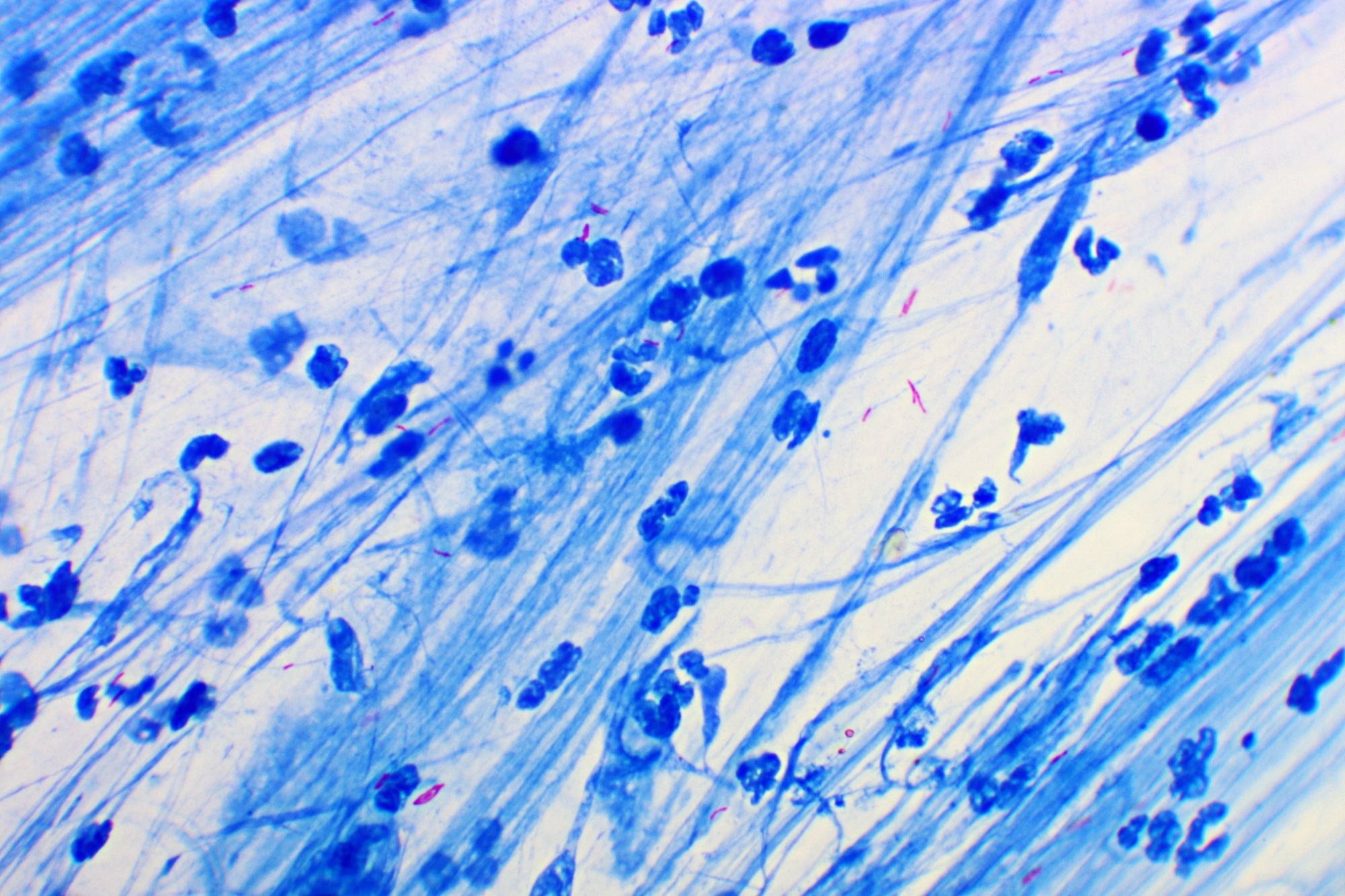 The metabolic consequences of HIV/TB co-infection