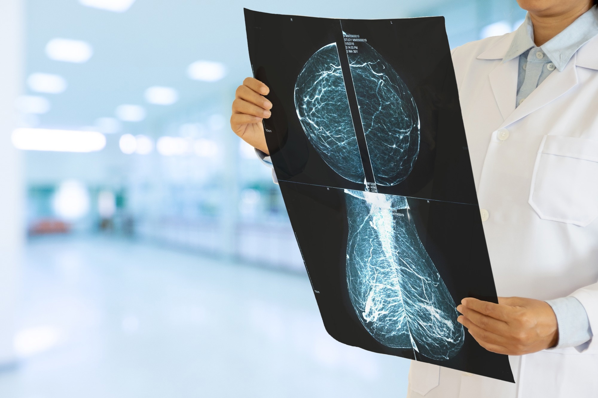 Study: Health benefits and harms of mammography screening in older women (75+ years)-A systematic review. Image Credit: ChooChin / Shutterstock.com
