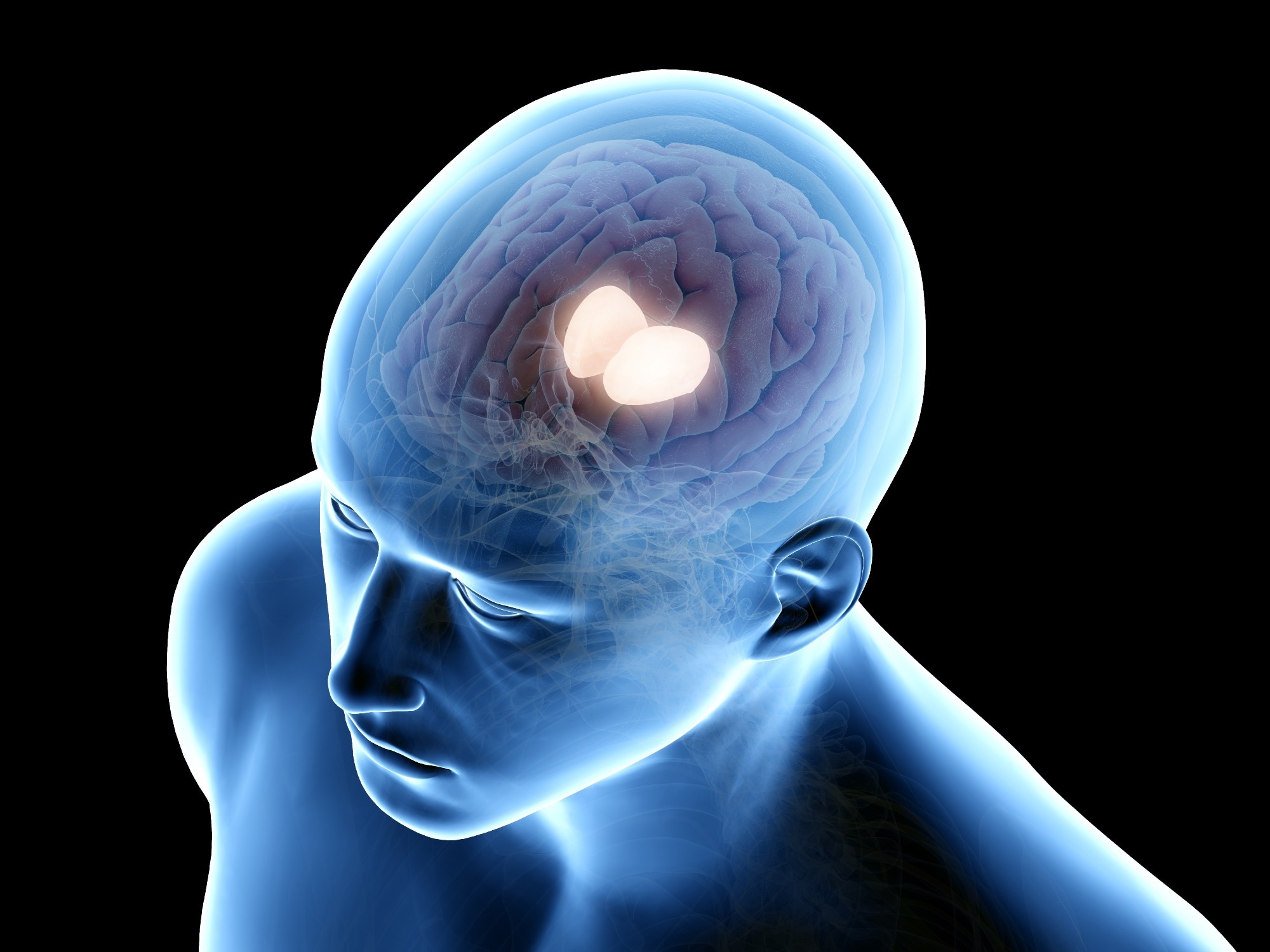 Study: Thalamic deep brain stimulation in traumatic brain injury: a phase 1, randomized feasibility study. Image Credit: SciePro / Shutterstock